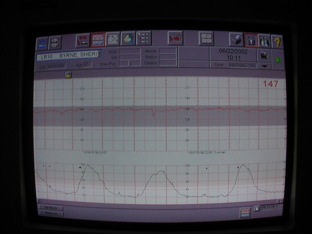 Earlier Contractions